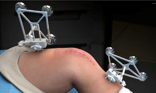 robotic-partial-knee-replacement-img3
